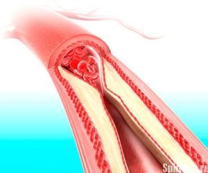 Инсульт спинного мозга Инсульт спинного мозга
