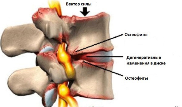 Спондилез крестцового отдела позвоночника Спондилез крестцового отдела позвоночника