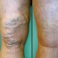 Можно ли придерживаться спортивного питания при гастрите? Можно ли придерживаться спортивного питания при гастрите?