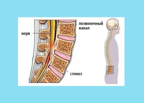 Поясничный стеноз позвоночника Поясничный стеноз позвоночника