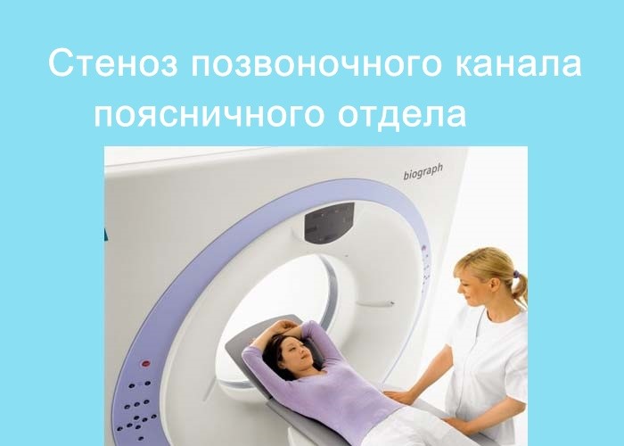 Поясничный стеноз позвоночника Поясничный стеноз позвоночника