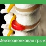 Поясничный стеноз позвоночника Поясничный стеноз позвоночника