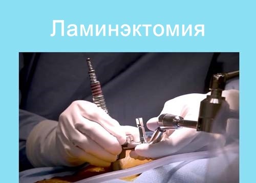 Поясничный стеноз позвоночника Поясничный стеноз позвоночника