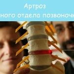 Поясничный стеноз позвоночника Поясничный стеноз позвоночника