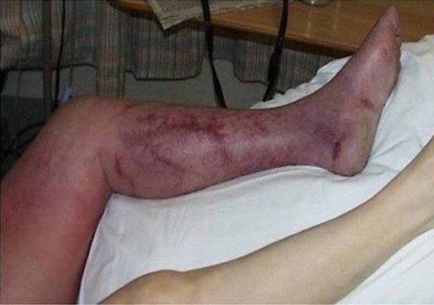 Окклюзия артерий ног и ее лечение Окклюзия артерий ног и ее лечение