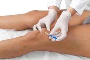 Тендинит сухожилия надостной мышцы Тендинит сухожилия надостной мышцы