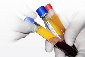 Тендинит сухожилия надостной мышцы Тендинит сухожилия надостной мышцы