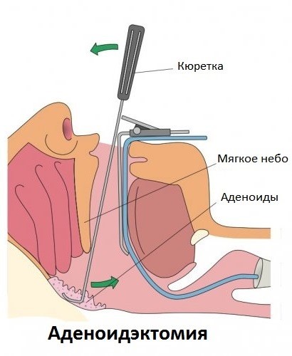Функция миндалин. Кому показана тонзиллэктомия? Функция миндалин. Кому показана тонзиллэктомия?