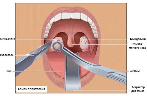Функция миндалин. Кому показана тонзиллэктомия? Функция миндалин. Кому показана тонзиллэктомия?