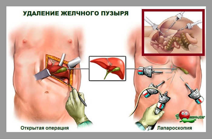 Побочные эффекты удаления желчного пузыря Побочные эффекты удаления желчного пузыря