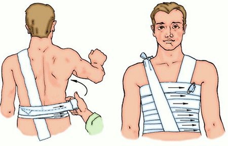 Симптомы трещины ребра и необходимое лечение Симптомы трещины ребра и необходимое лечение