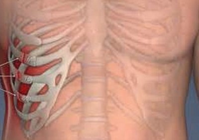 Симптомы трещины ребра и необходимое лечение Симптомы трещины ребра и необходимое лечение