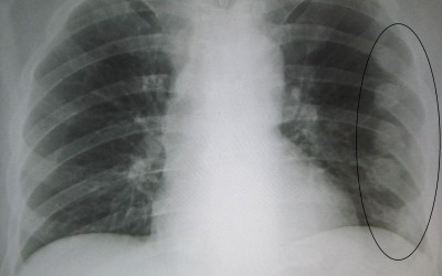 Симптомы трещины ребра и необходимое лечение Симптомы трещины ребра и необходимое лечение