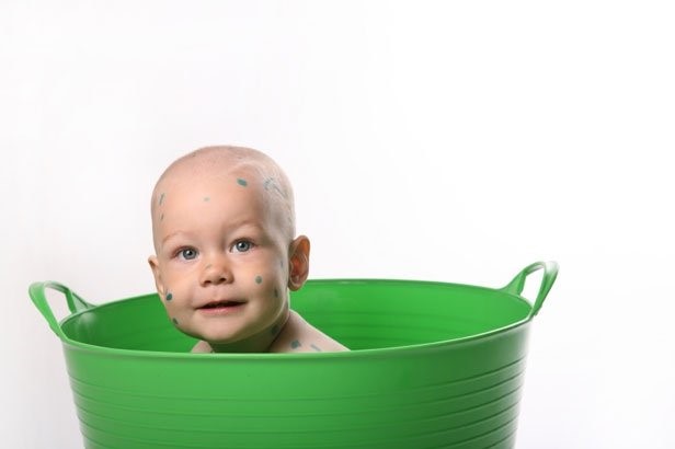 Как и почему образуются язвы при варикозе? Как и почему образуются язвы при варикозе?