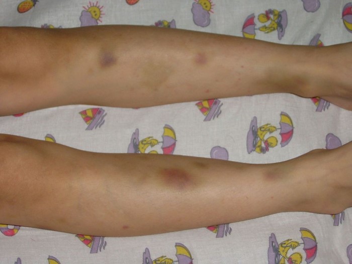 Тромбоцитопеническая пурпура Тромбоцитопеническая пурпура