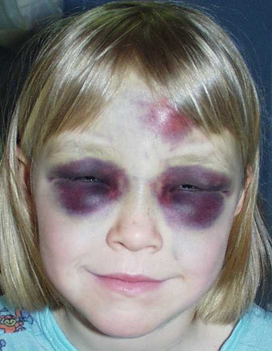 Тромбоцитопеническая пурпура Тромбоцитопеническая пурпура