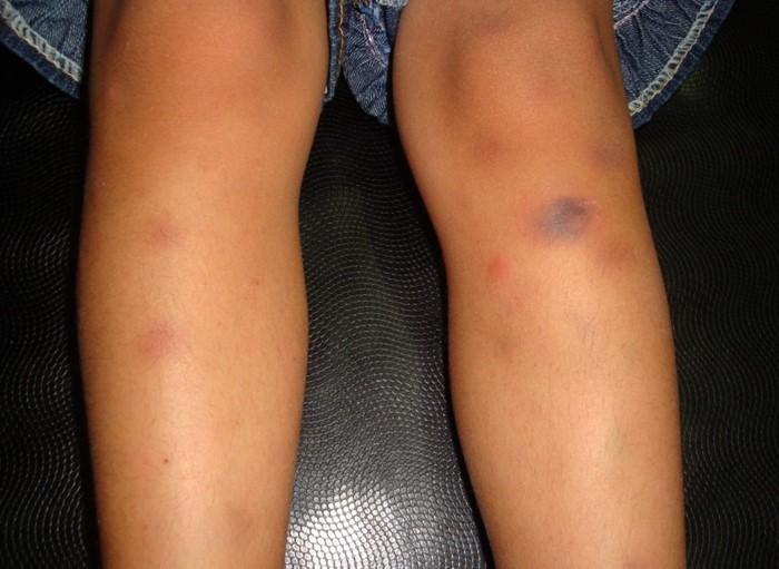 Тромбоцитопеническая пурпура Тромбоцитопеническая пурпура