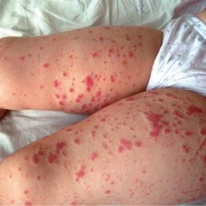 Тромбоцитопеническая пурпура Тромбоцитопеническая пурпура