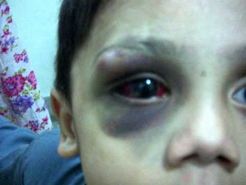 Тромбоцитопеническая пурпура Тромбоцитопеническая пурпура