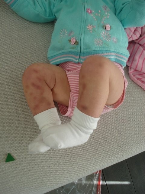 Тромбоцитопеническая пурпура Тромбоцитопеническая пурпура