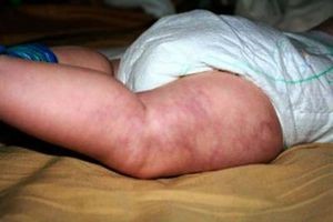 Тромбоцитопеническая пурпура Тромбоцитопеническая пурпура