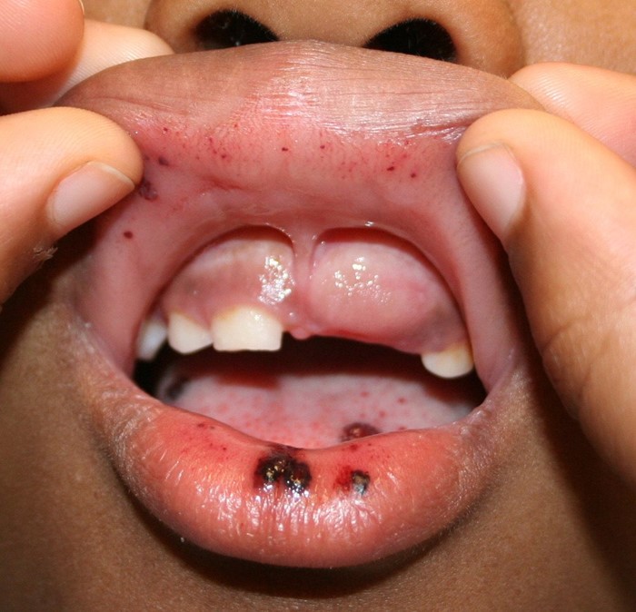 Тромбоцитопеническая пурпура Тромбоцитопеническая пурпура