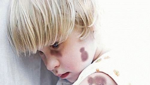 Тромбоцитопеническая пурпура Тромбоцитопеническая пурпура