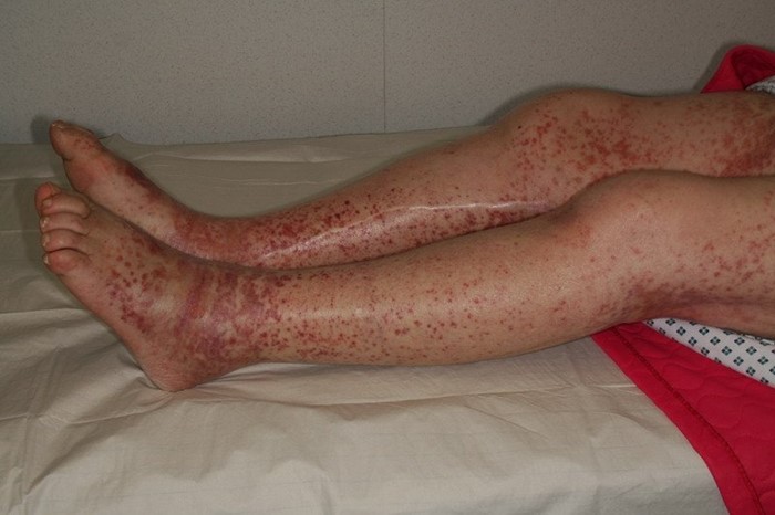 Тромбоцитопеническая пурпура Тромбоцитопеническая пурпура