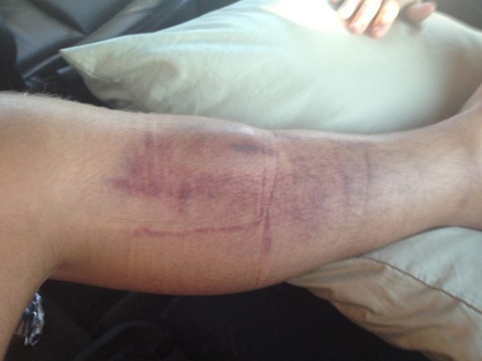 Тромбоцитопеническая пурпура Тромбоцитопеническая пурпура