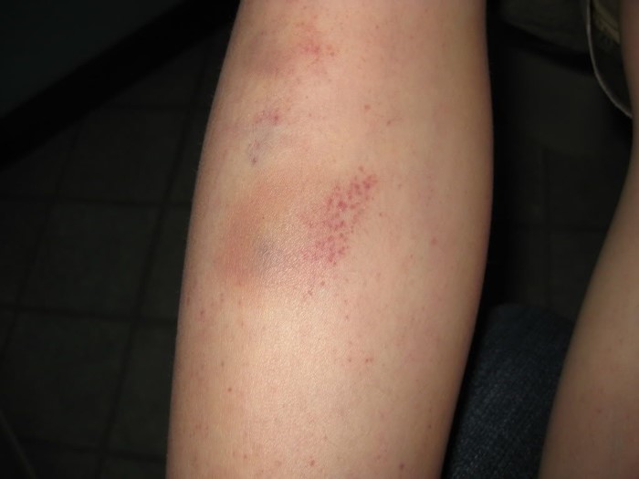 Тромбоцитопеническая пурпура Тромбоцитопеническая пурпура