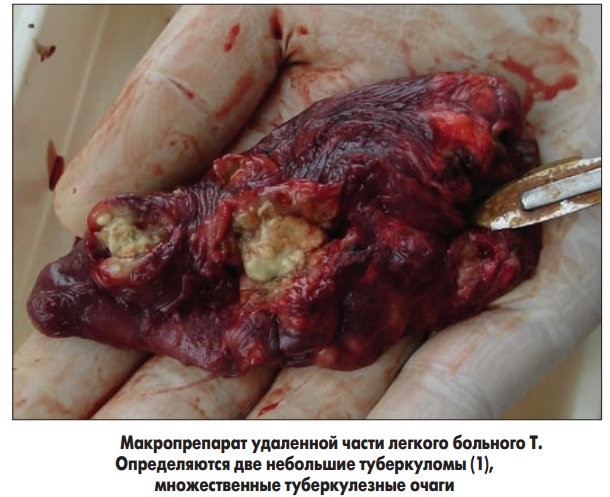 Туберкулема легких - что это такое и как выполнять лечение Туберкулема легких - что это такое и как выполнять лечение