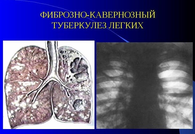 Туберкулема легких - что это такое и как выполнять лечение Туберкулема легких - что это такое и как выполнять лечение