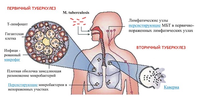 Туберкулема легких - что это такое и как выполнять лечение Туберкулема легких - что это такое и как выполнять лечение