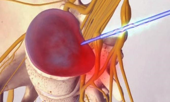 Лазерное лечение межпозвоночной грыжи Лазерное лечение межпозвоночной грыжи