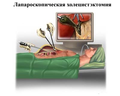 После удаления желчного пузыря проблемы с пищеварением После удаления желчного пузыря проблемы с пищеварением