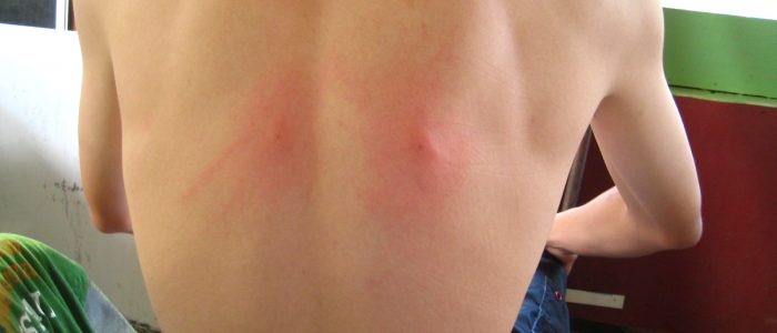 На спине появилась шишка болит На спине появилась шишка болит