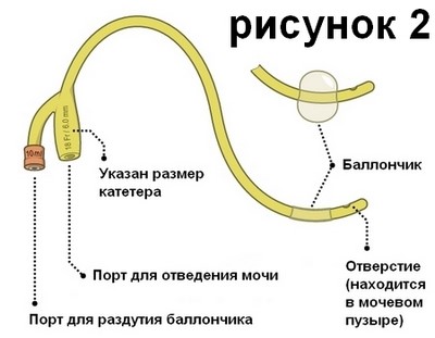 Цистостома мочевого пузыря Цистостома мочевого пузыря