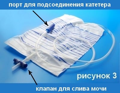 Цистостома мочевого пузыря Цистостома мочевого пузыря