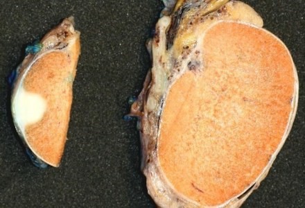 Что нужно знать об УЗИ почек и надпочечников? Что нужно знать об УЗИ почек и надпочечников?