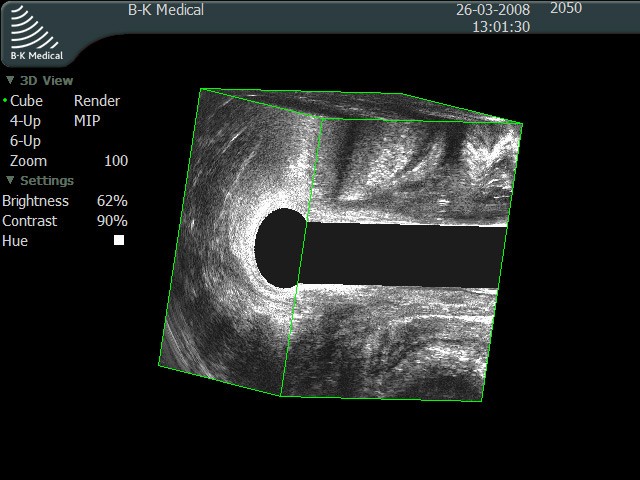 Как делают УЗИ прямой кишки? Как делают УЗИ прямой кишки?