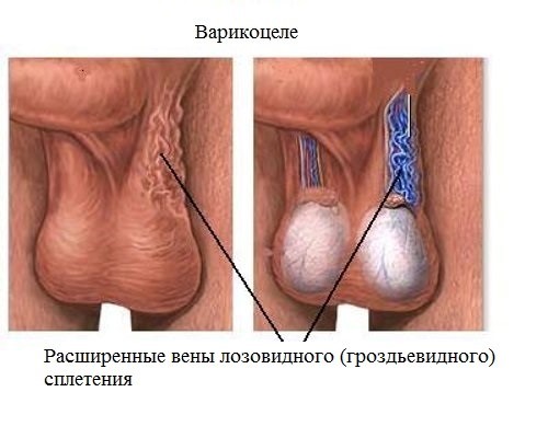 Симптомы и причины появления варикоцеле Симптомы и причины появления варикоцеле