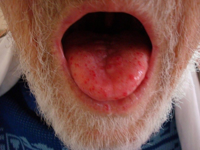 Детская сыпь у ребенка в горле Детская сыпь у ребенка в горле