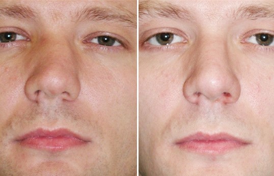 Проведение операции по исправлению носовой перегородки Проведение операции по исправлению носовой перегородки