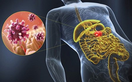 Вирусный гастроэнтерит Вирусный гастроэнтерит