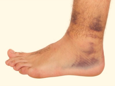 Симптомы и методы лечения вывиха лодыжки Симптомы и методы лечения вывиха лодыжки
