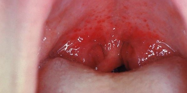 Волдыри в горле Волдыри в горле