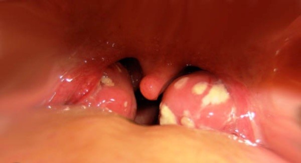 Волдыри в горле Волдыри в горле