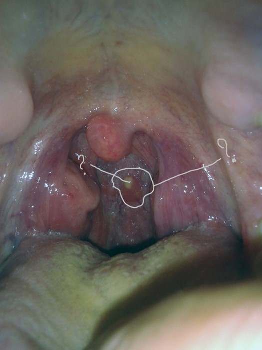 Волдыри в горле Волдыри в горле