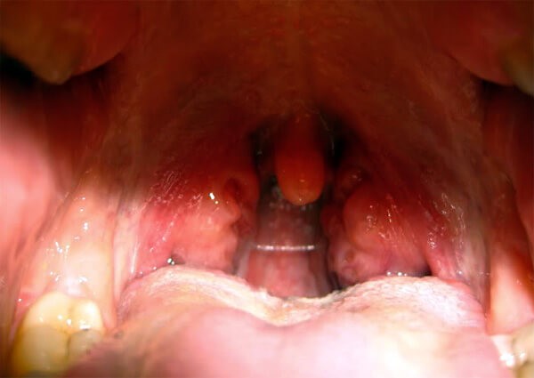 Волдыри в горле Волдыри в горле