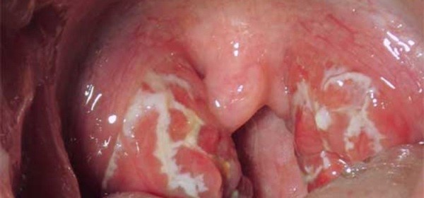 Волдыри в горле Волдыри в горле